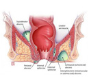 肛管直肠周围脓肿治疗前的注意事项？